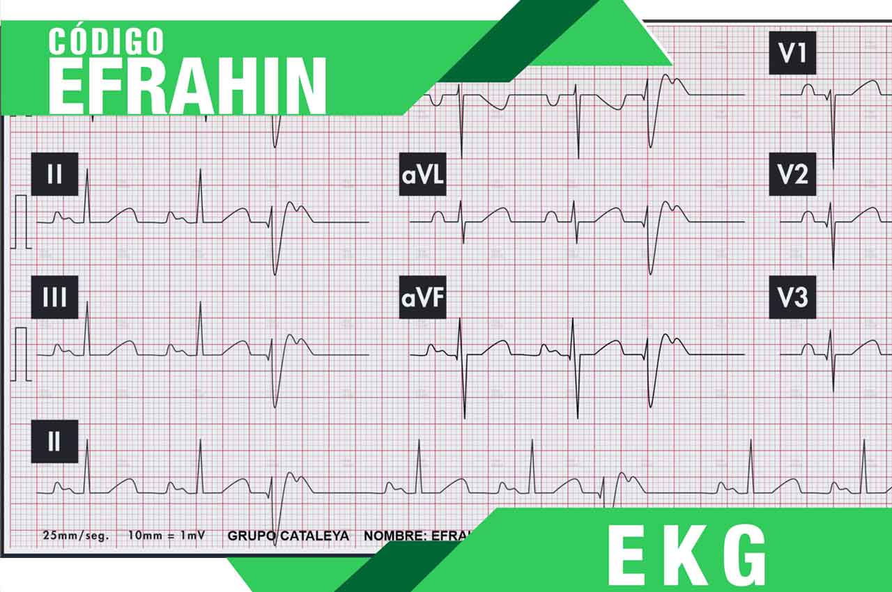 Código EFRAHIN: La clave para la interpretación del electrocardiograma